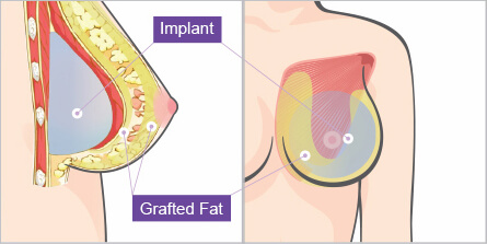 Combined Breast Augmentation