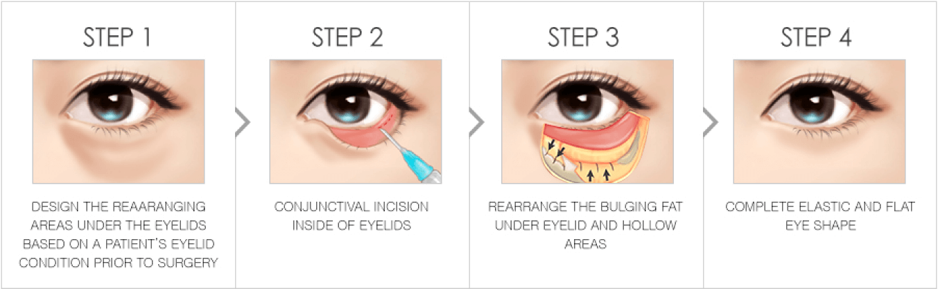 Get rid of dark circles and bulging fat under your eyes