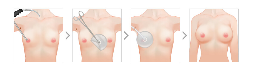 Secure space for breast implants using HD endoscopy equipment for breast surgery