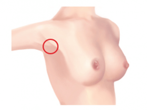 Areola incision