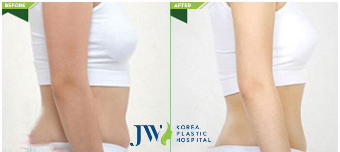 Before and after arm Liposuction