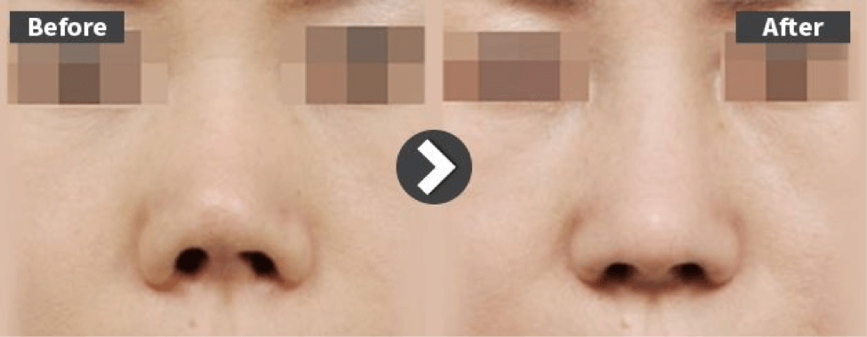 Shortened nose with contracture