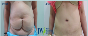 Total Abdominoplasty (liposuction and tummy tuck)