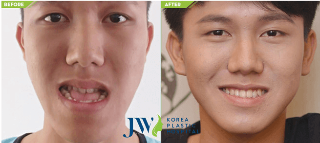 The result of underbite correction surgery without braces