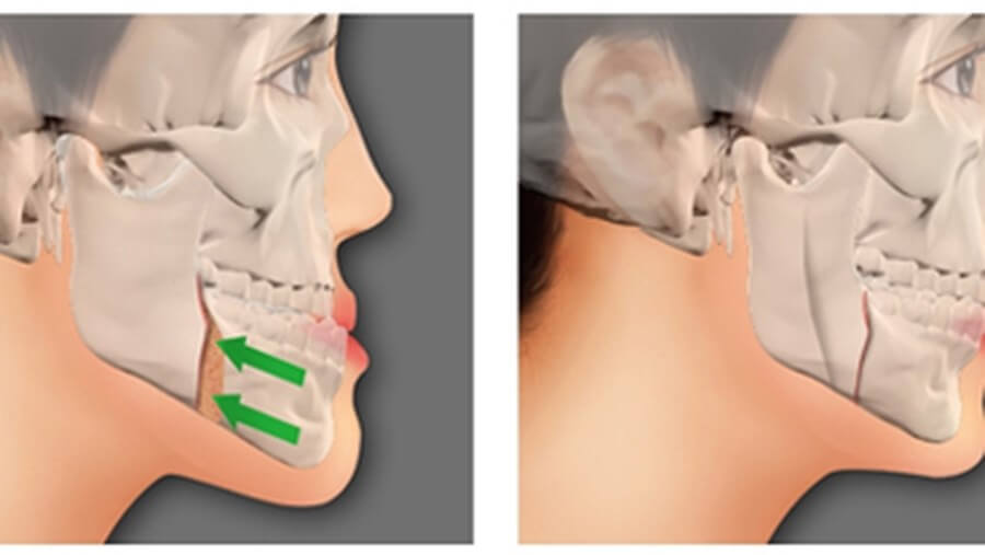 BSSO – the method for lower jaw surgery