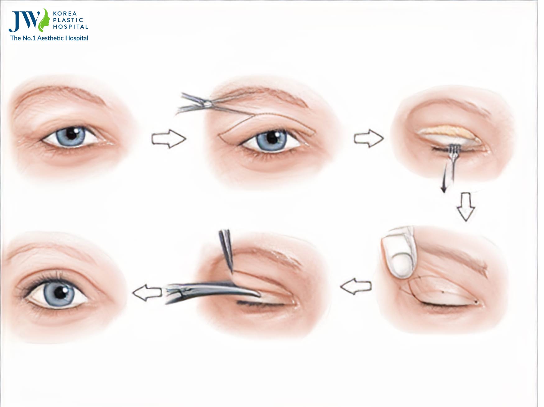 Upper Blepharoplasty-jw