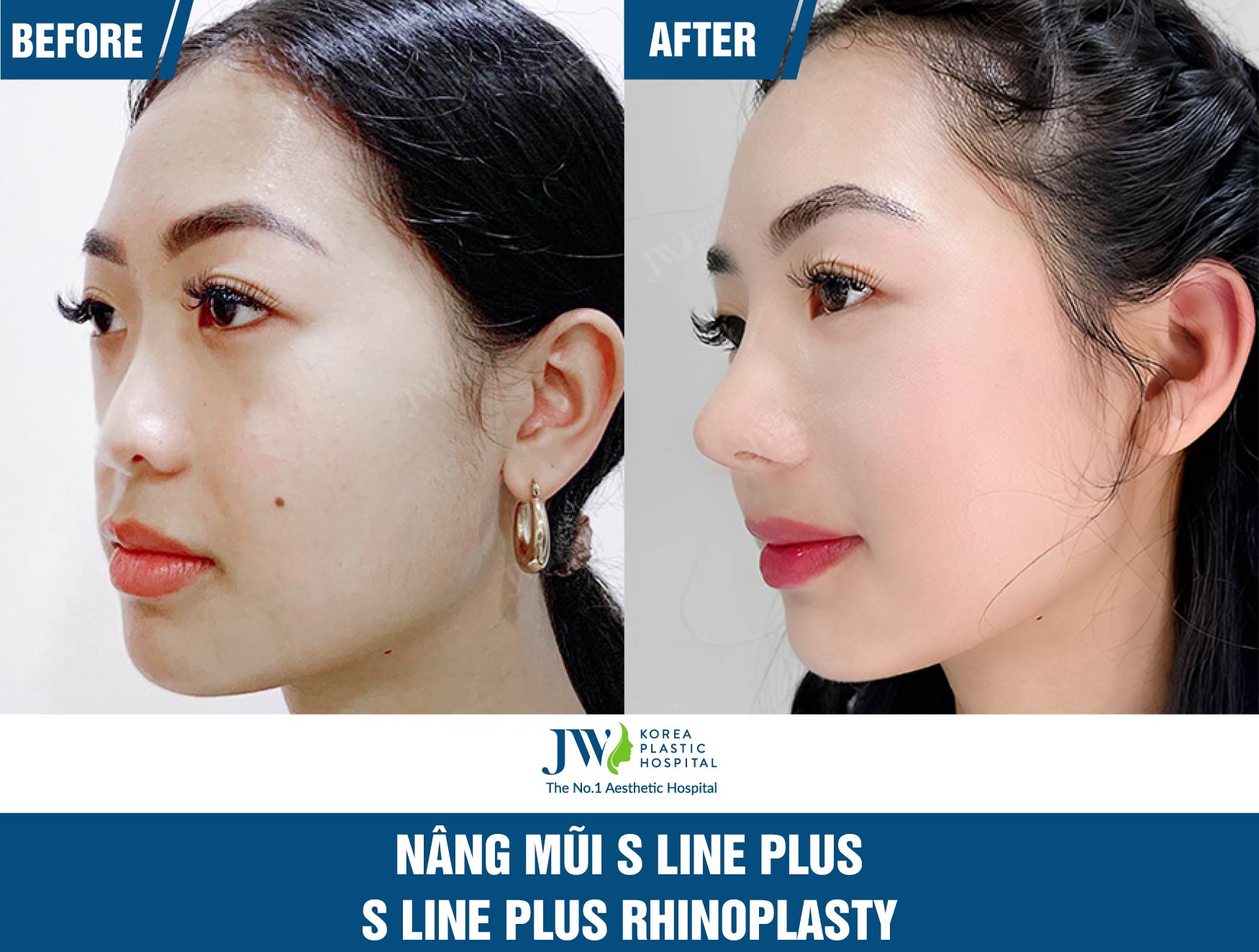 S-Line-Plus-Rhinoplasty-jw