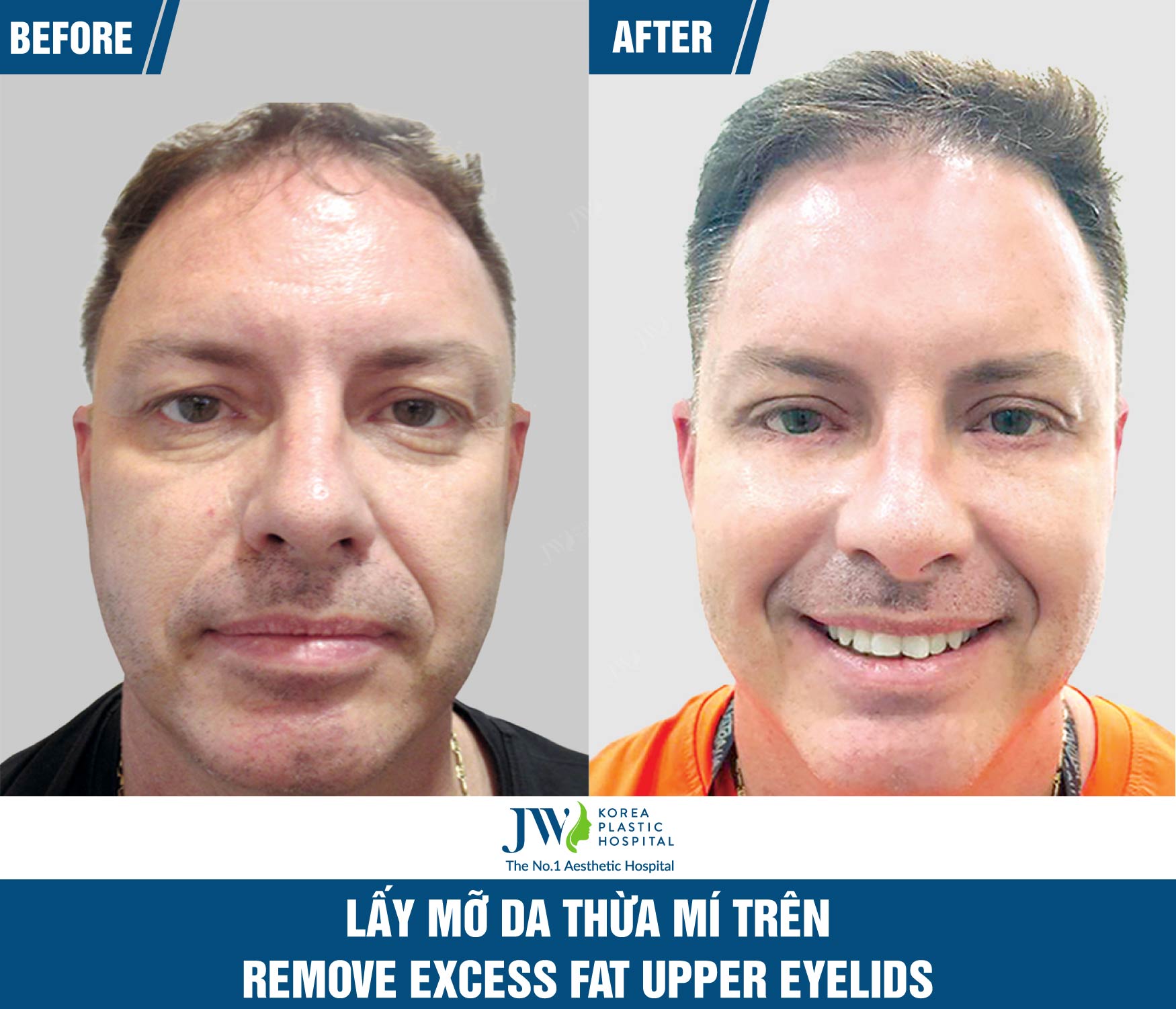 eye-rejuvenation-at-jw