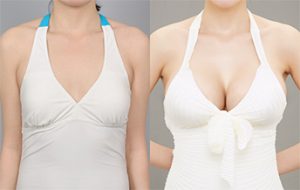 Breast Augmentation with Nano Chip