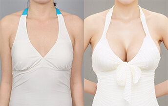 Breast Augmentation with Nano Chip JW Korean Plastic Hospital