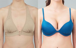 Breast Reconstruction