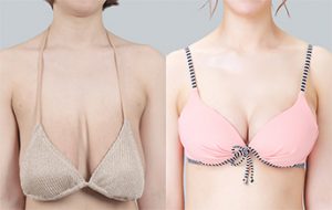 Breast Reduction – Transform Overly Large and Sagging Breasts Into Beautiful and Bouncy Breasts