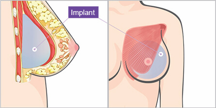 Tear drop Implant Breast Augmentation by using of HD Endoscopy