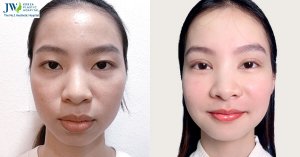 Double Eyelid Surgery: A Guide to a More Confident You