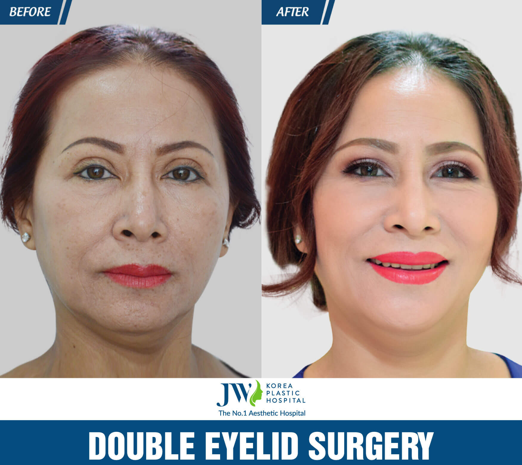 double eyelid surgery