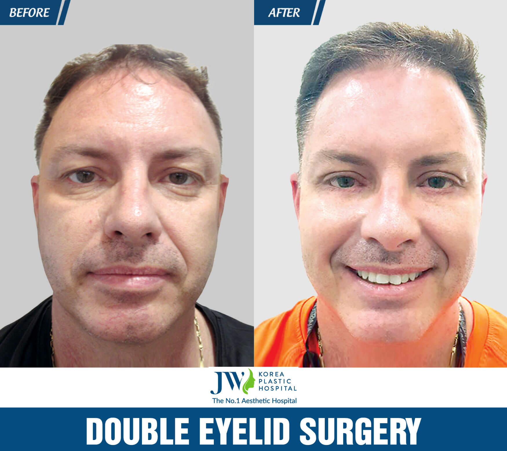 double eyelid surgery