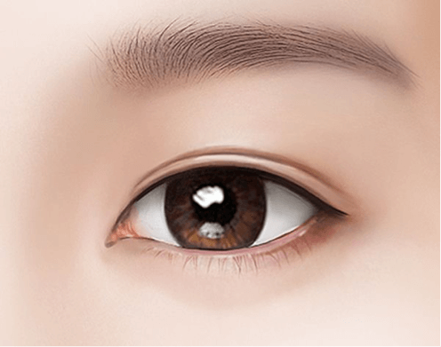 Slim and natural looking eyelids after the muscle and fats are removed.