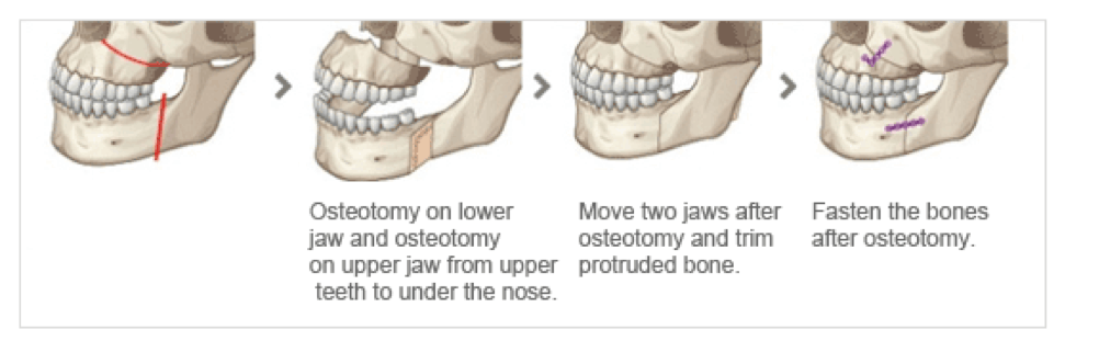 shifted jaw shifted jaw