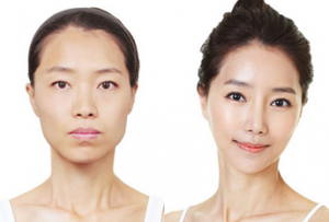 Corrective Jaw Surgery