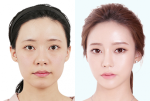 V-Line Surgery: Your Path to a Refined, Youthful Face