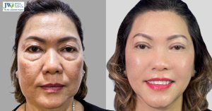 Mid-Face 3-in-1: A Comprehensive Facial Rejuvenation