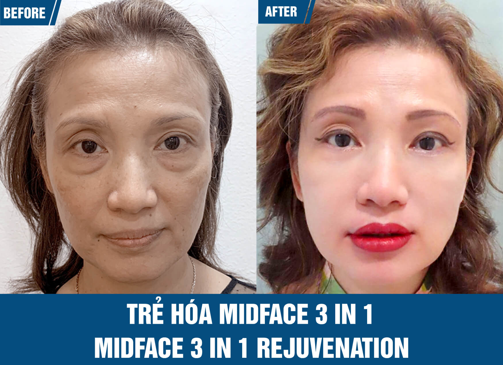 Remove eye bags, wrinkles