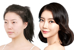 S line Rhinoplasty