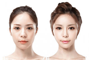 Hump Reduction Rhinoplasty: Enhancing Your Nasal Profile