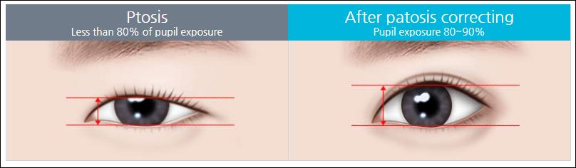 Features of Ptosis Correction