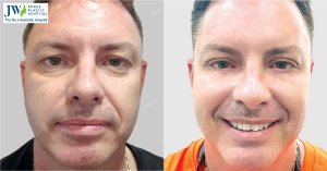 Upper Blepharoplasty