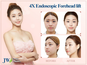 4X Endoscopic Forehead Lift