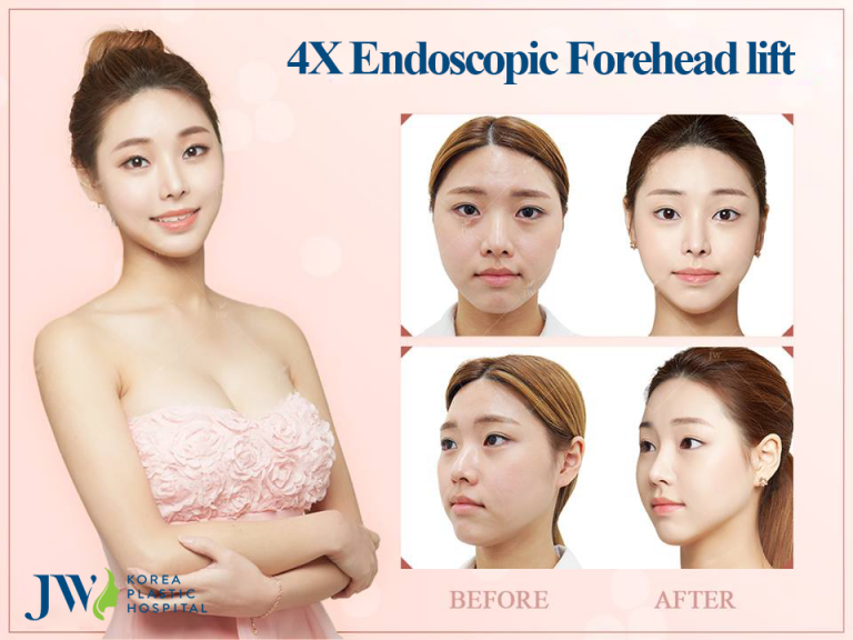 4X Endoscopic Forehead Lift JW Korean Plastic Hospital