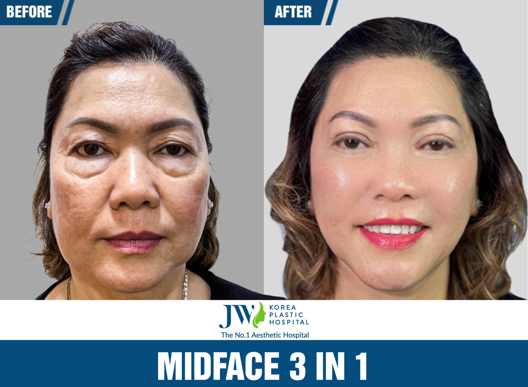 midface 3 in 1