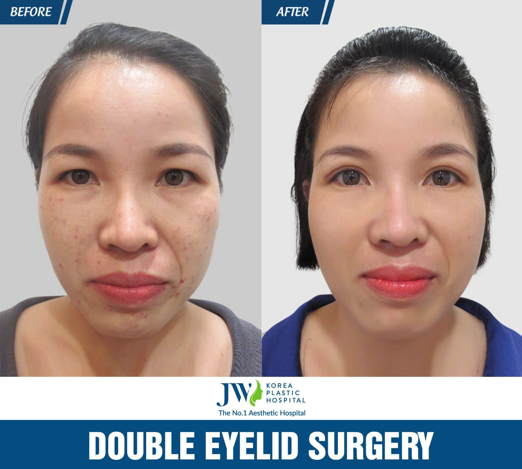 Eyelid-Surgery jw