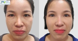 Elevate Your Look with Personalized Eyelid Surgery