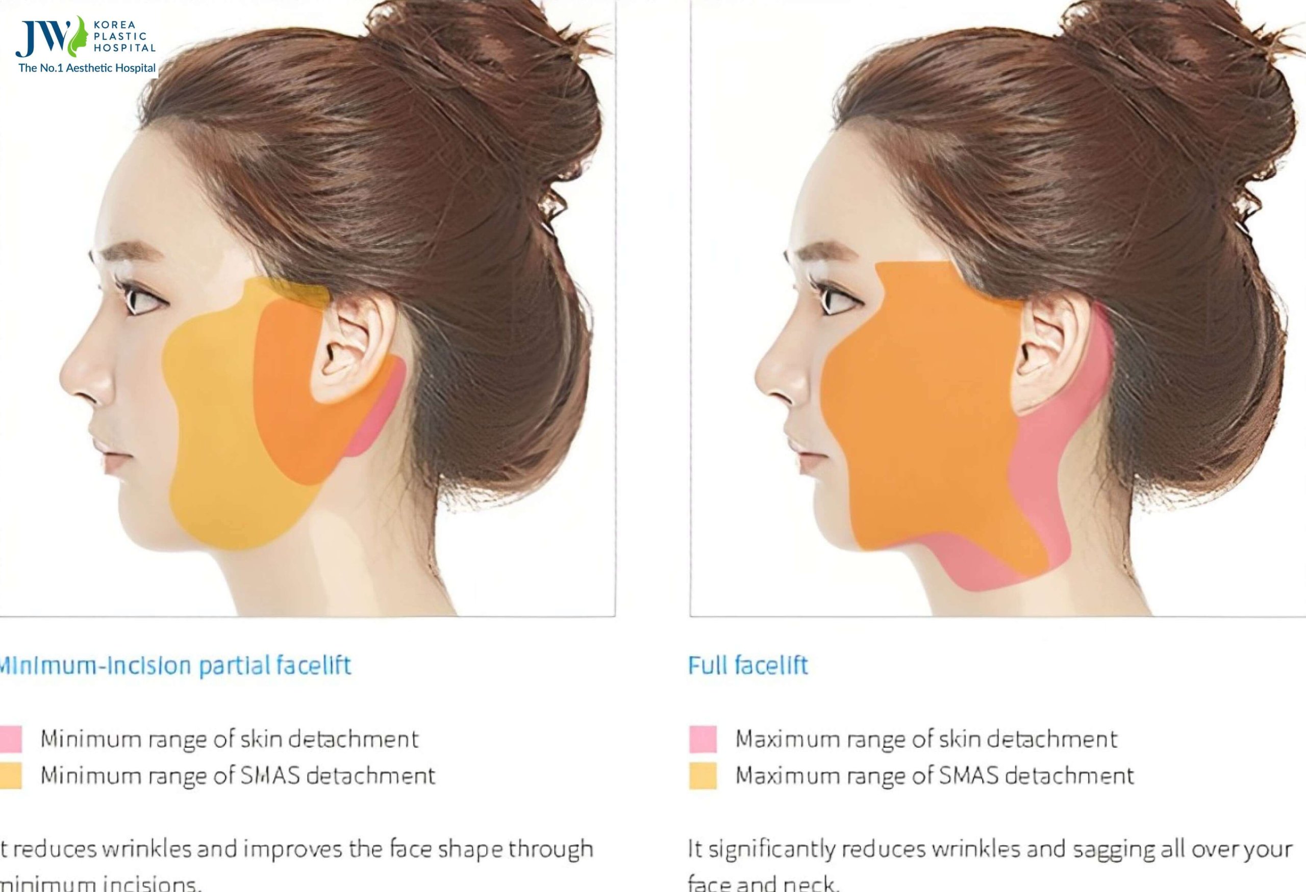 Facelift procedure at JW