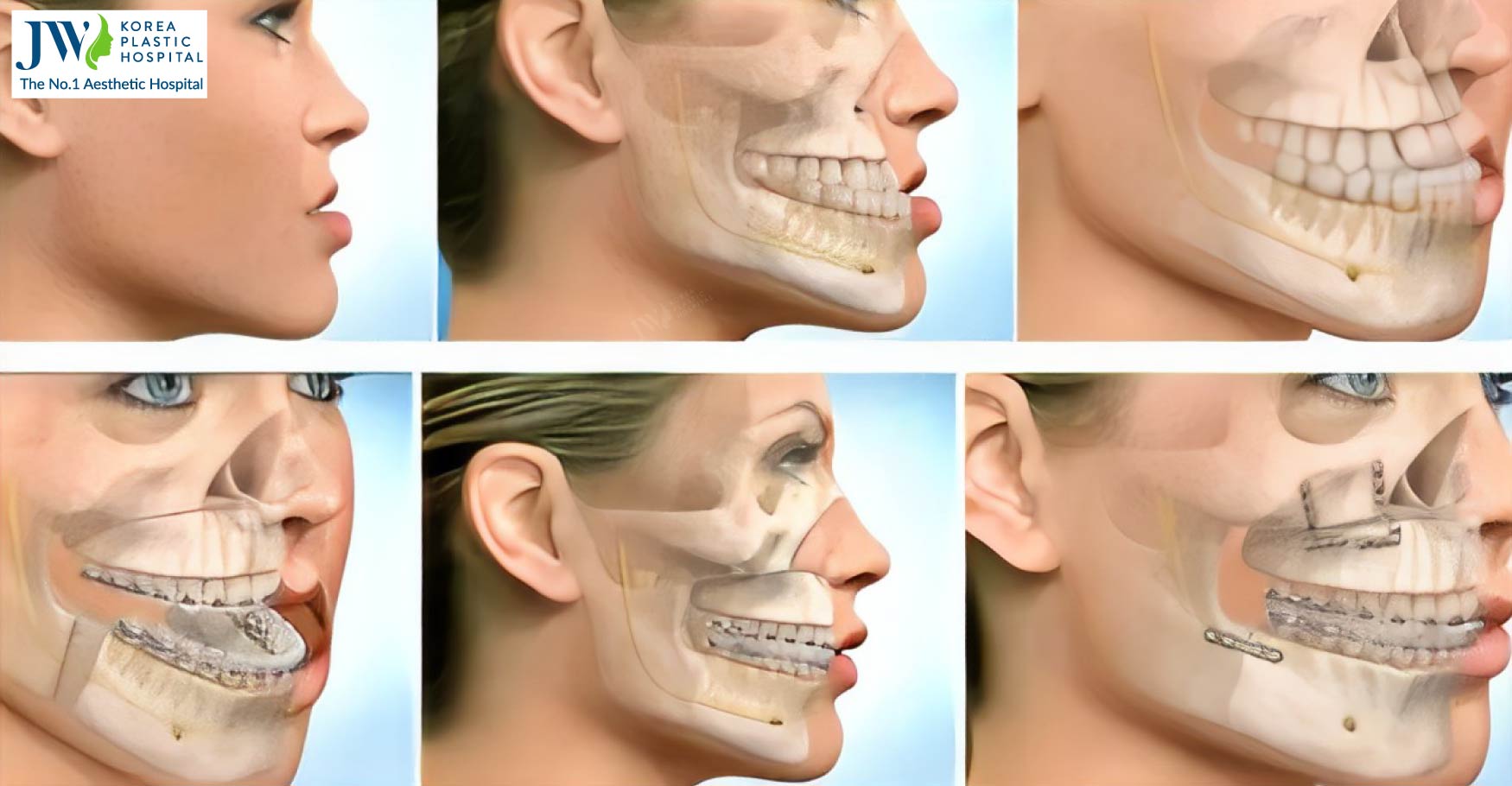 BSSO Lower Jaw Surgery 