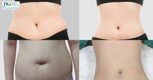 Rediscover Your Confidence: Transform Your Tummy with a Personalized Tummy Tuck