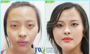 A Girl Got Double Eyelid Surgery to Looks Like A Celebrity