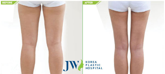 Before and after thighs liposuction