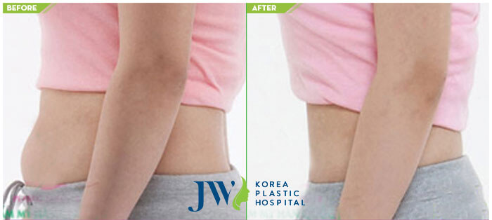 Before and after abdomen liposuction