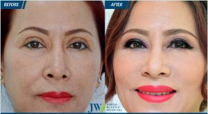 Revision Eyelid Surgery –  JW Plastic Surgery Hospital