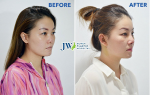 Revision Rhinoplasty: A Second Chance for Your Nose