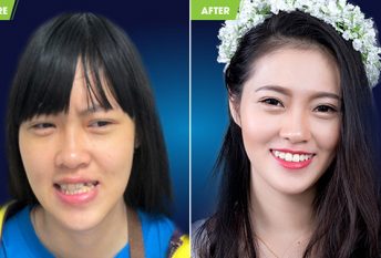 The result of combining braces and surgery