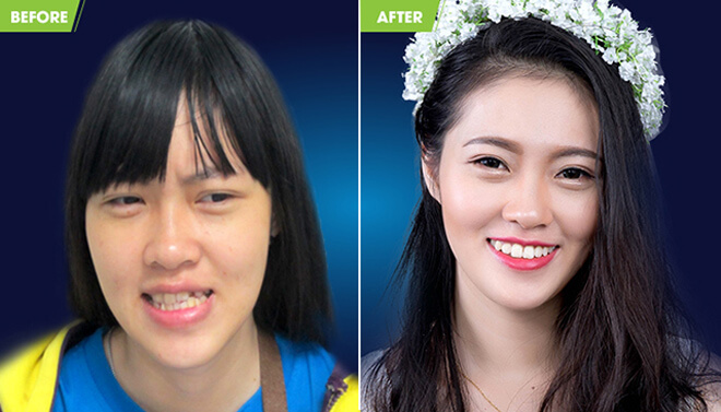 The result of combining braces and surgery