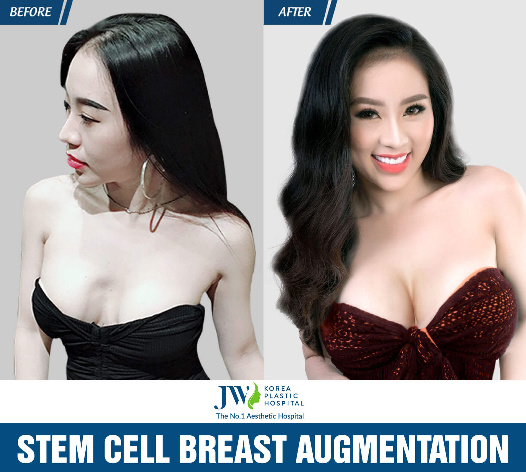 stem-cell-breast-augmentation-1