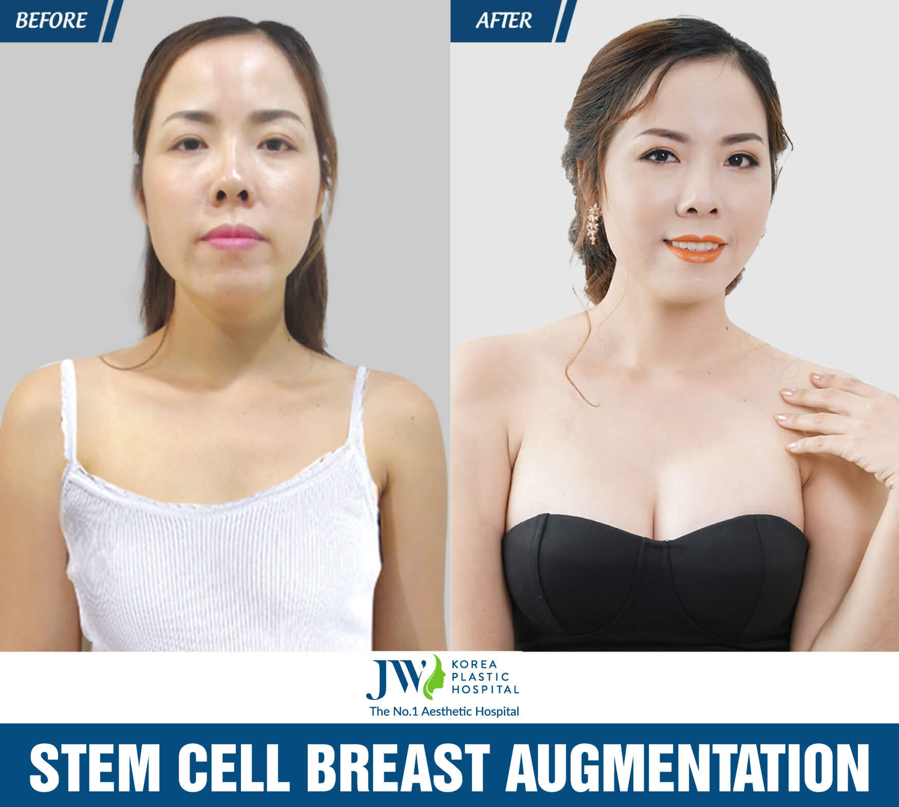 stem-cell-breast-augmentation-at-jw