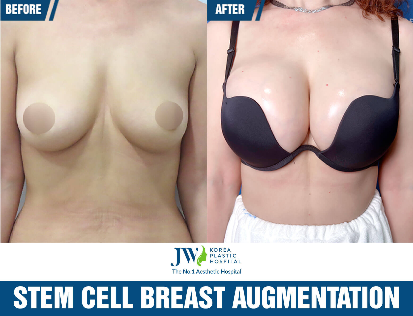 stem-cell-breast-augmentation-at-jw