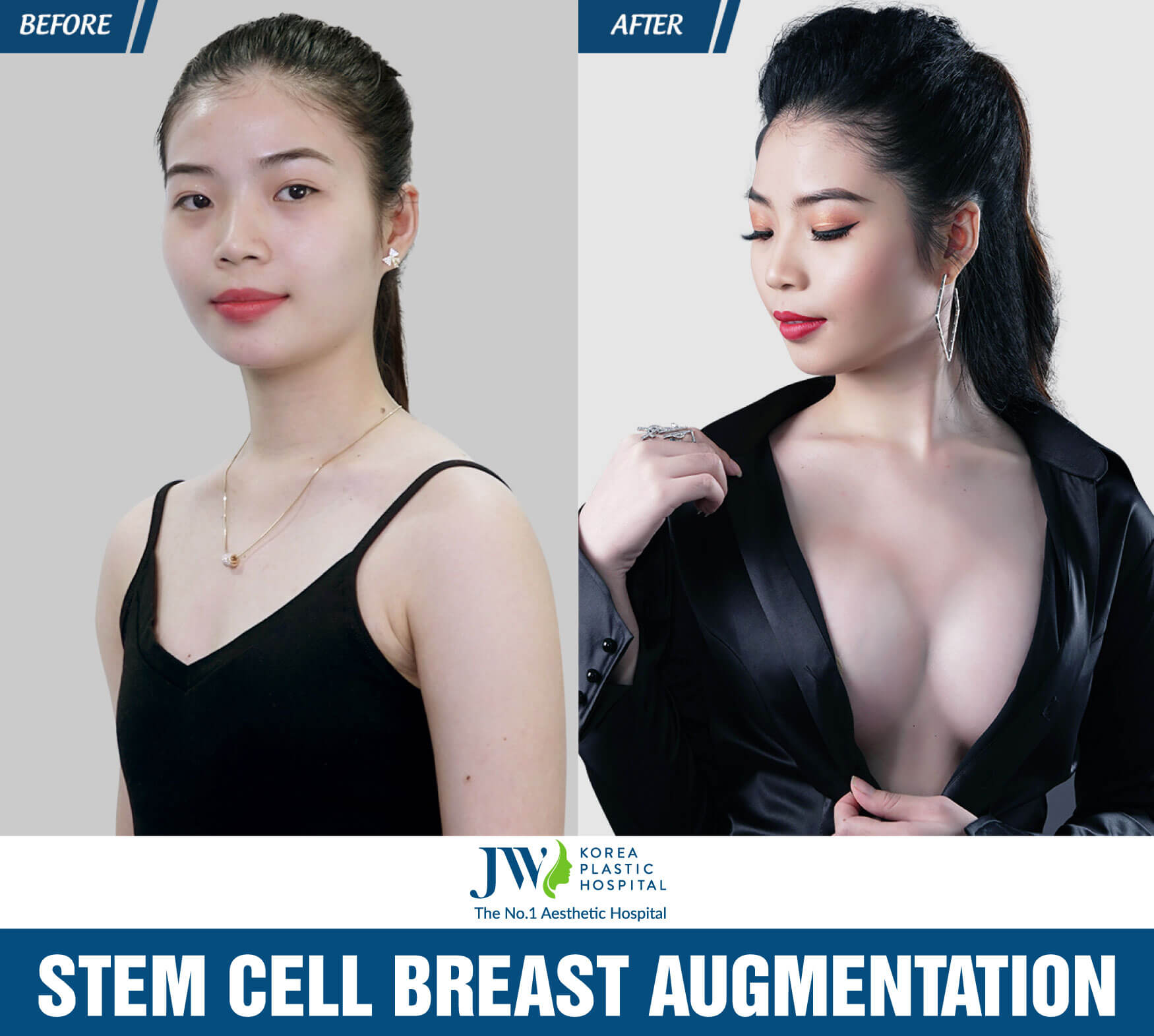 stem-cell-breast-augmentation-at-jw