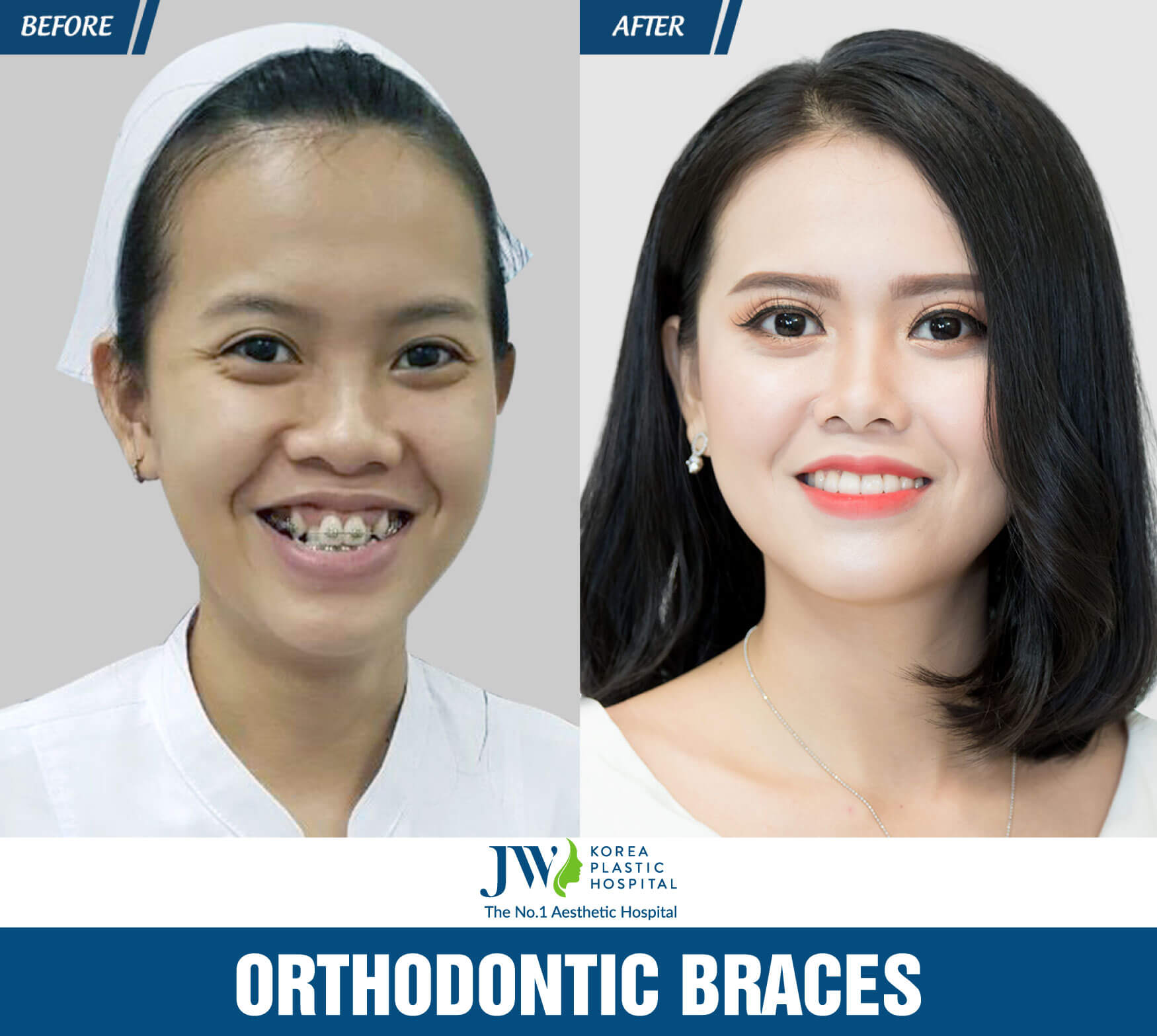 Orthodontic Braces